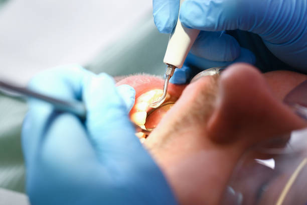 Best Emergency Wisdom Teeth Removal in Home, WA